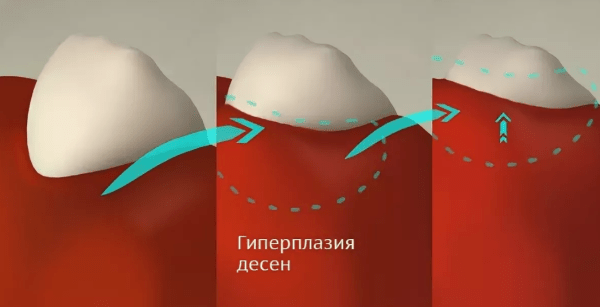Гиперплазия соединительной ткани: причины, симптомы и методы лечения